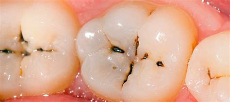 dental cavities discover health