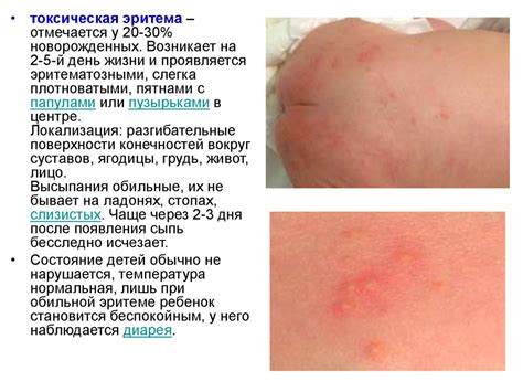 Физиологические состояния новорожденного - online presentation