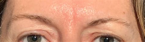 Ptosis de ceja - oclanda
