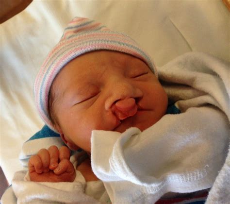 Our Cleft Journey Archives - Just Call Me Homegirl | Cleft lip, Cleft ...