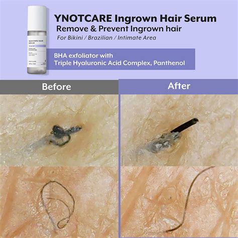 How To Remove Hair From Male Genital Area at Jamie Gibb blog