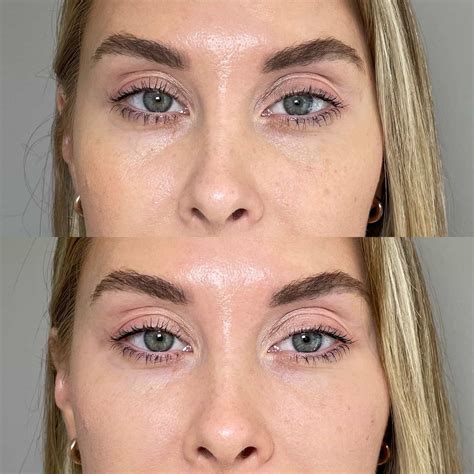 Tear Trough Filler - Under Eye Filler - Kingston Upon Thames, Surrey