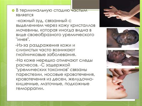 Хроническая почечная недостаточность - презентация онлайн