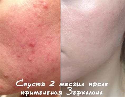 Применение Зеркалина против прыщей - отзывы и фото - jlica.ru