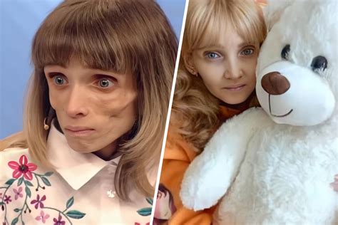 Весила всего 17 кг. Как сегодня выглядит победившая анорексию Кристина ...