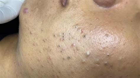Forget Everything You Know: Unbelievable Blackhead Removal 2024 Revealed - 1h2zx3j