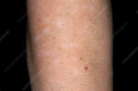 depigmentation  skin  psoriasis stock image  science