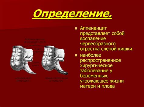 Аппендицит у беременных - презентация онлайн