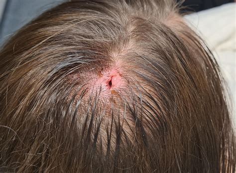 20 year old cyst popped! Doc put plastic piece in to drain puss and now