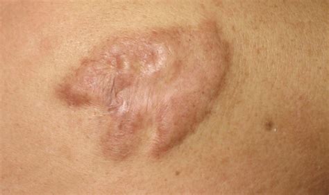 scars keloid scar pediatric dermatology
