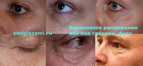 Варикоз глаз: если появились вены под глазами