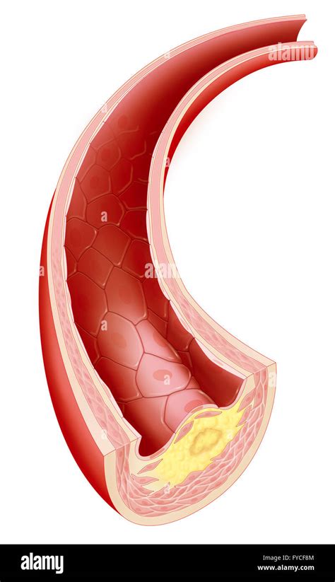 El ateroma, dibujo Fotografía de stock - Alamy