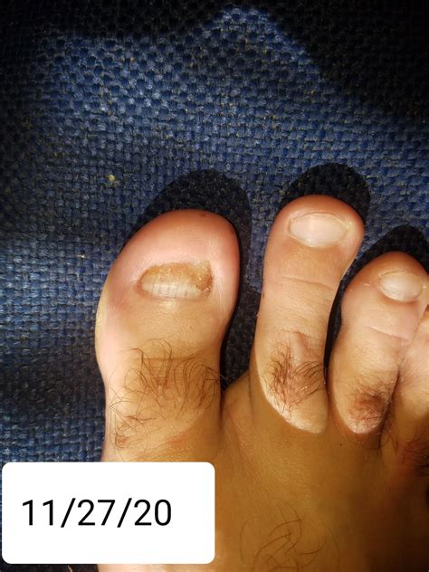 Terbinafine after 5 months with pictures - what do you think? : NailFungus