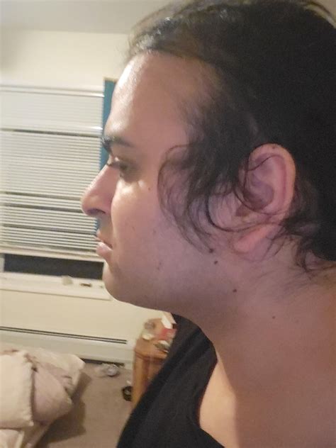 Surgery recommendations : r/Transgender_Surgeries