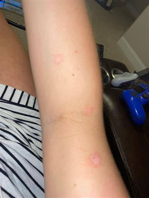 Eczema patches on skin?? : r/Accutane