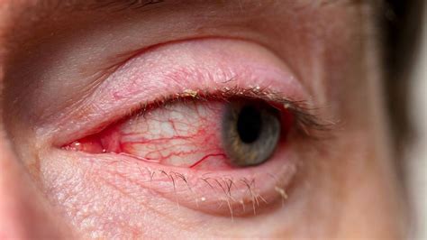 Worst Case Of Pink Eye