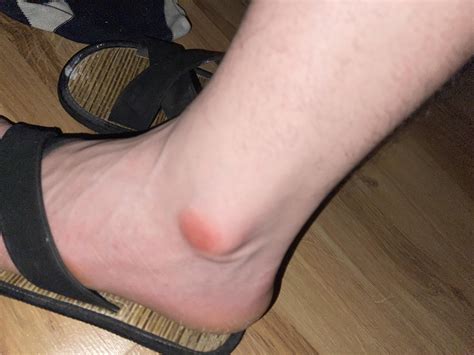 Sprained my ankle almost 3 years ago and it looks like this and feels