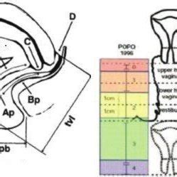pelvic organ prolapse quantification  scientific diagram