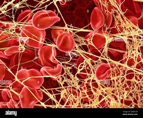 Blood clot. Coloured scanning electron micrograph (SEM) of red blood ...