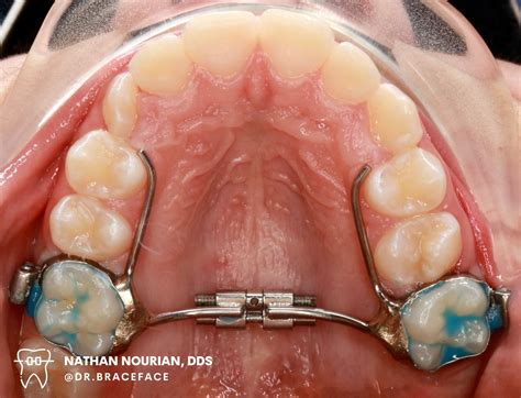 How To Turn Rapid Palatal Expander (RPE) Los Angeles, CA