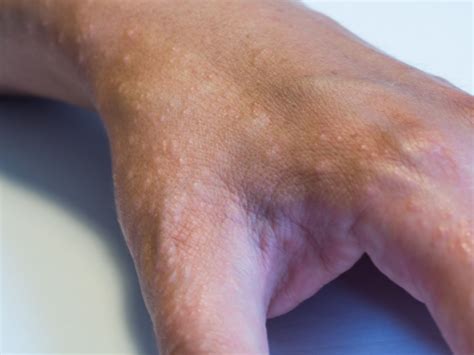 dyshidrotic dermatitis symptoms  diagnosis  treatment