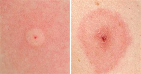 Insect Bites