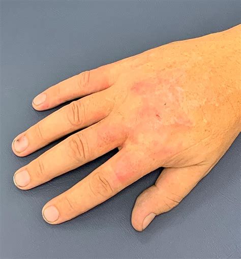 Burns and Scar Management - SA Hand Therapy