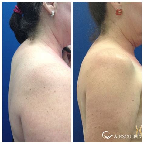 Dorsocervical fat pad (also known as buffalo hump) is when fat ...