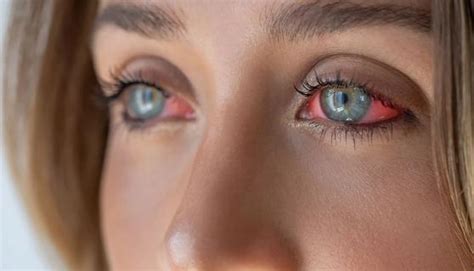 Tear Burns: Why Do My Eyes Burn When I Cry?