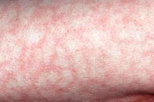 indications-anticoagulants - CREATIF