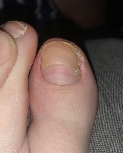 My toenail grew in extra thick during my pregnancy then abruptly