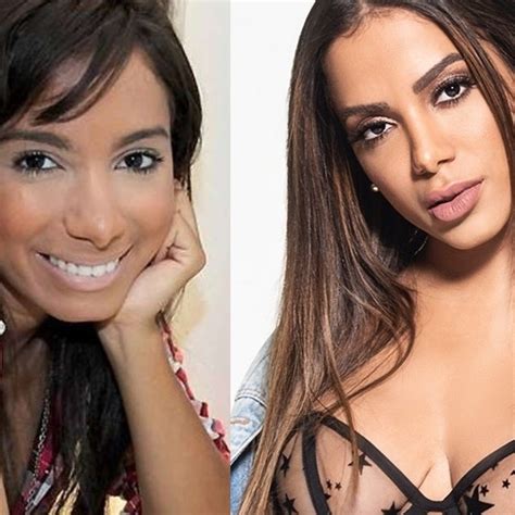 Anitta Antes E Depois Das Plasticas