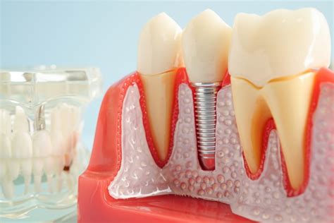 single tooth replacement options treat plaza dental concord california