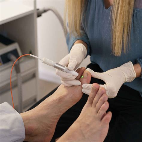 Laser Fungal Nail Treatment - Synergy Sports and Wellness Centre