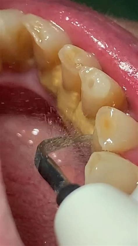 Pin by Lejla Chocki on реклама стомат аиодент | Dental videos, Healthy ...