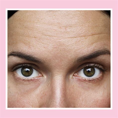 Forehead Wrinkles London | Frown line Reduction Options