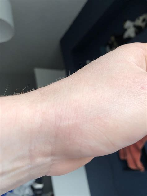 Is this a burrow : r/scabies