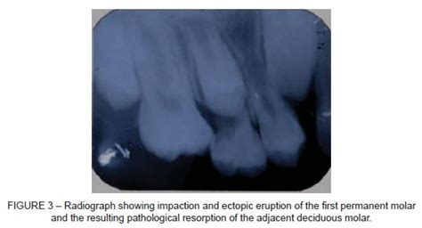 Clinical management of the ectopic eruption of a maxillary first ...