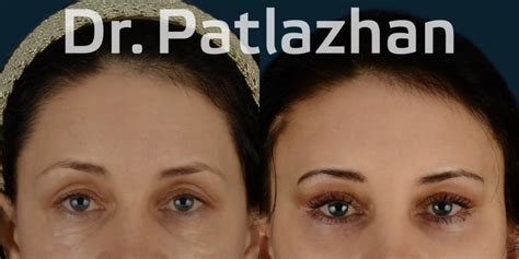 Эндоскопическая подтяжка лица (лифтинг) в Киеве, Одессе, Днепре - «Dr ...