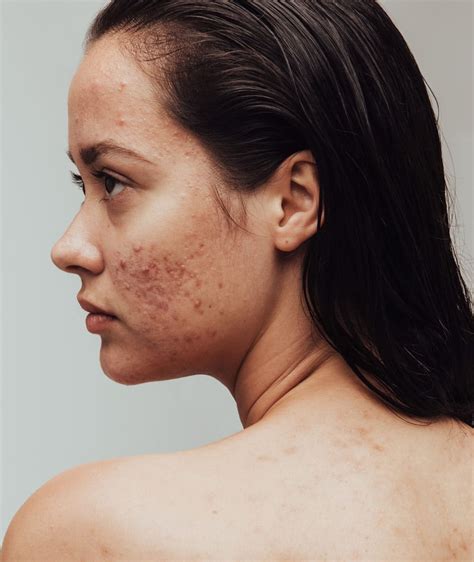 Acne | Dr Grace Kelly Aesthetics Clinic | Buckinghamshire