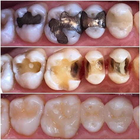 dental amalgam restoration