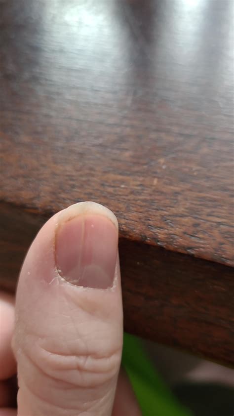 Split nail : r/medical