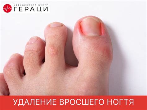 Удаление вросшего ногтя у хирурга в Ростове-на-Дону