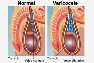 O Que É Varicocele No Homem - Quando fazer a cirurgia de varicocele, como é feita e recuperação - Tua ...