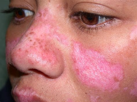 ¿Que es el lupus? :: Medicalsos