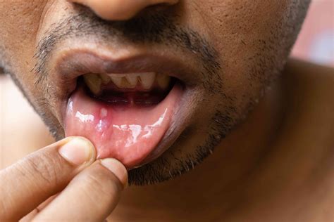 gum line canker sore 5