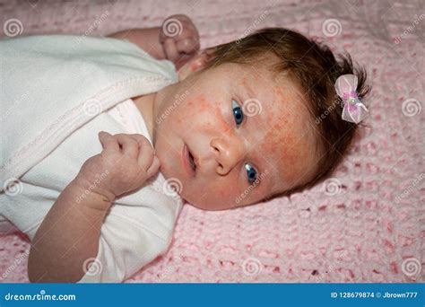 Newborn With Severe Baby Acne Possibly From An Adverse Reaction To ...