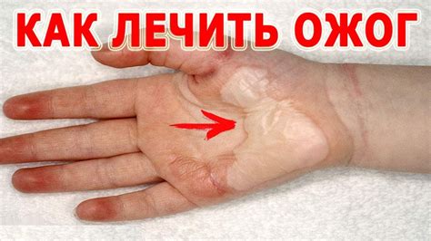 Как лечить ожог. Чего нельзя делать при ожогах. Как лечить ожог ...