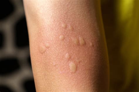 Stop the Scratching: Solutions to Manage Drug Allergy Rash