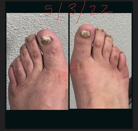Terbinafine Progress: 4 months : r/NailFungus
